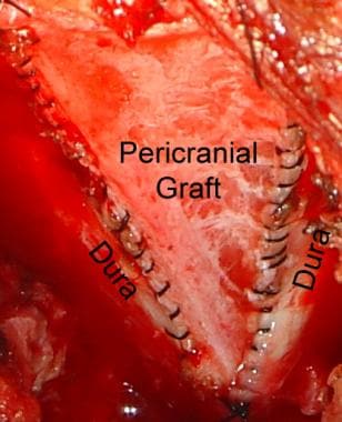 Intraoperative photograph of duraplasty with peric