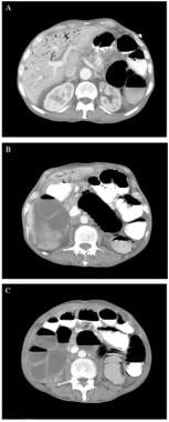 Peritonitis and abdominal sepsis. A 78-year-old ma