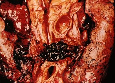 Deep Venous Thrombosis (DVT). A pulmonary embolus 