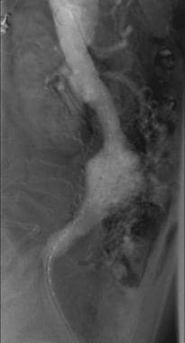 Lateral arteriogram demonstrates infrarenal abdomi