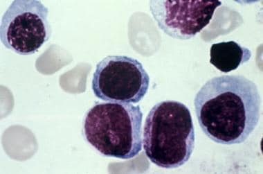 Bone marrow aspirate showing erythroblasts in a pa