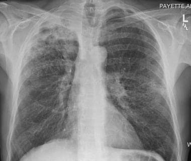 Chest radiograph in a patient with classic right u
