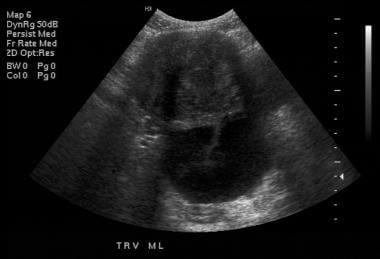 Transabdominal ultrasonogram shows anechoic tubula