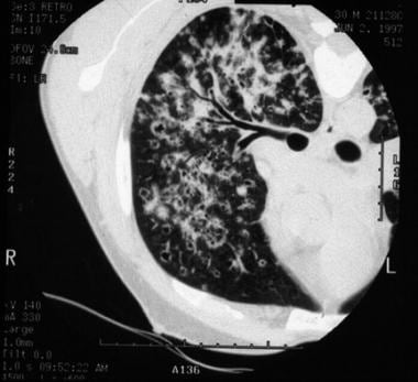 High-resolution chest CT scan of patient with bila