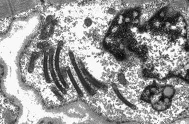 Electron micrograph showing abnormal mitochondria,