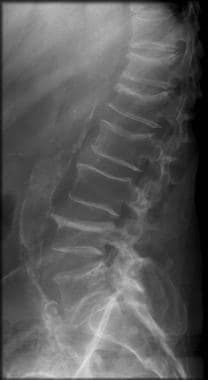 Severe osteoporosis. This radiograph shows multipl