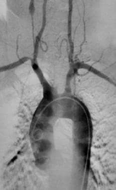 Takayasu arteritis. Complete occlusion of the left