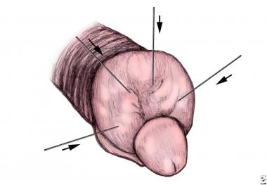 Paraphimosis Treatment Management Approach Considerations