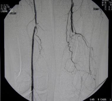 Upper Limb Vascular Disease