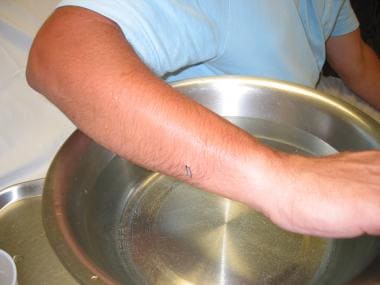 Stingray barb in forearm. Photo by John L. Meade, 