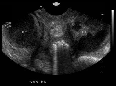 Endovaginal ultrasound scan. Endometritis with air