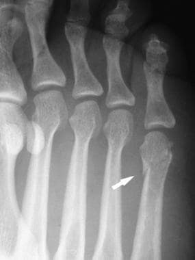 Fractures, foot. Minimally displaced fracture of t