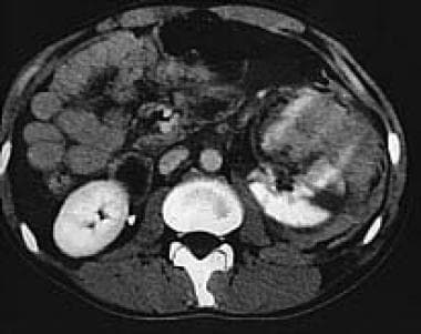 Ruptured left kidney. 