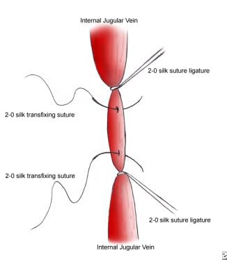 2-0 silk sutures and suture ligatures are placed a