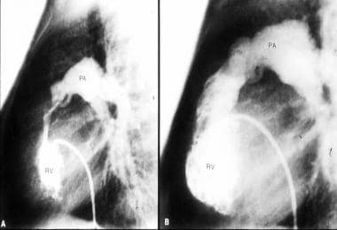 Valvar Pulmonary Stenosis. Selected frames from th
