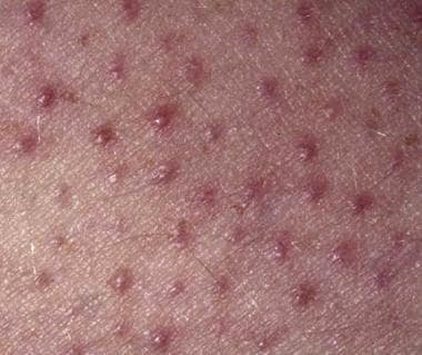 Bacteria associated with the follicular papules of