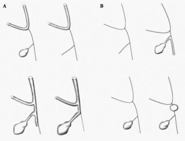 Biliary atresia. 