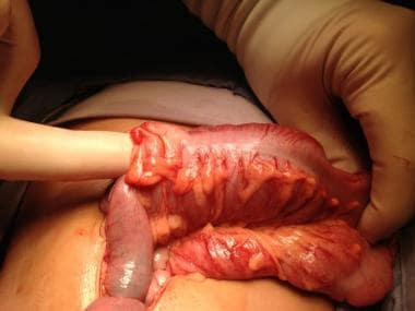 Pediatric Small Bowel Obstruction. The surgical ph