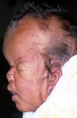 In this profile photo, turribrachycephaly (high pr