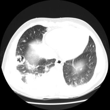 CT scan of the thorax (lung windows) of a 15-year-