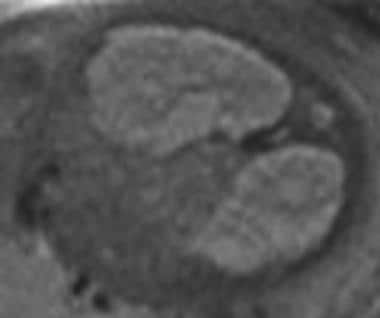 T2-weighted MRI shows bilateral smooth enlarged ki