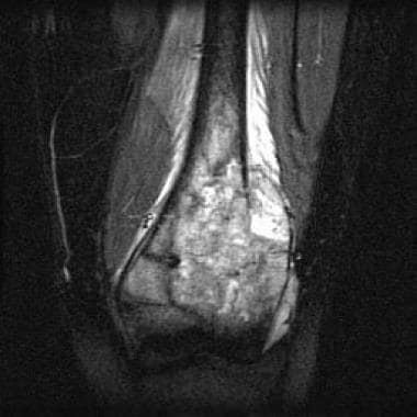 Close-up MRI of the same distal femoral osteosarco