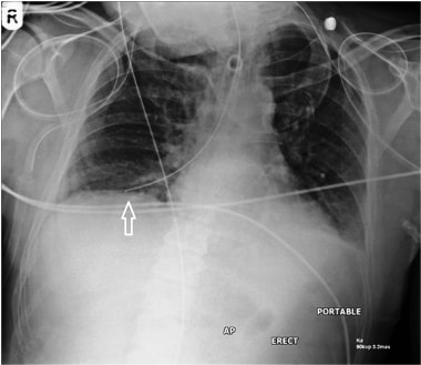 A case of misplaced nasogastric tube. Note the pos