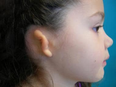 Patient with most common type of microtia (ie, gra