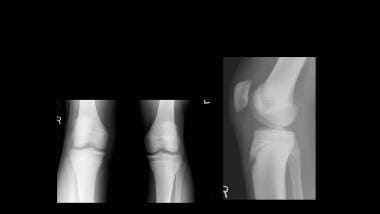 Growth plate (physeal) fractures. Proximal tibia a