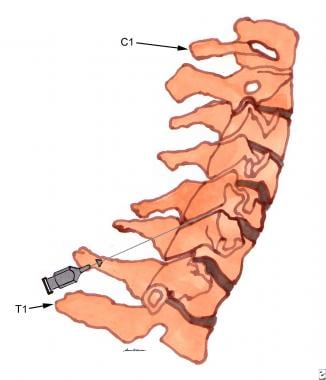 Cervical spine local injection technique into the 