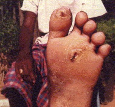 Plantar trophic ulcers in a patient with leprous n