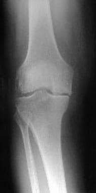 Preoperative radiograph of a medial unicompartment