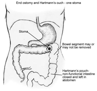 Illustration of portion of colon that would be rem