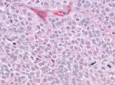 Higher magnification of the metastatic granulosa c