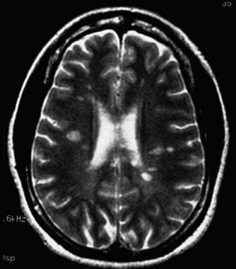 MRI of a 26-year-old woman with progressive disequ