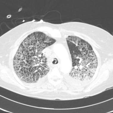 CT scan of chest in patient with pulmonary alveola