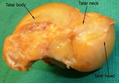 Medial surface of the talus bone. 