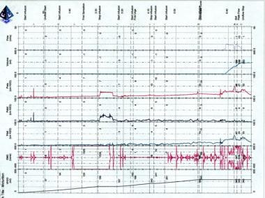 Uroflowmetry: What are its normal values, in which diseases is it performed?