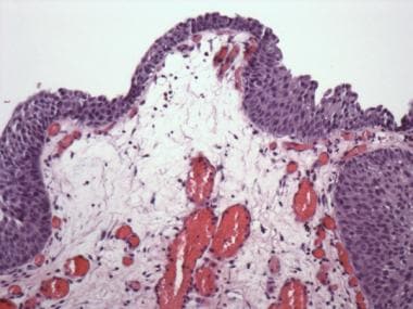 Pathology of Cystitis. Polypoid cystitis. Broad, p