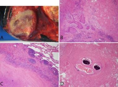 A）肺dirofilariasis：纶的大体标本