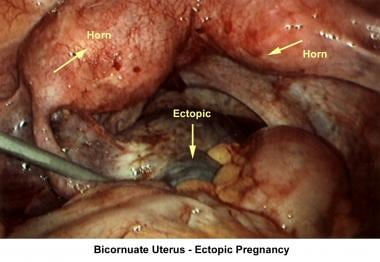 Infertility. Bicornuate uterus - Ectopic pregnancy