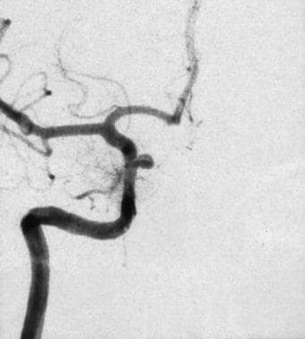 Left oblique cerebral angiogram in a patient with 