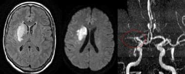 MRI was subsequently obtained in the same patient.