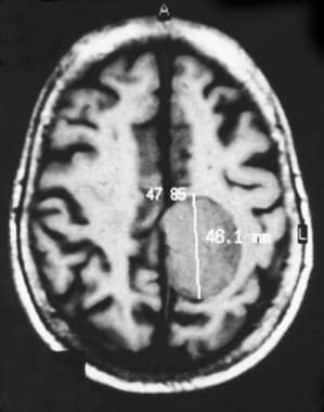 Nonenhanced axial magnetic resonance image demonst