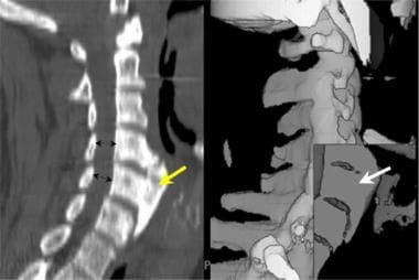 This midline sagittal multireformatted computed to