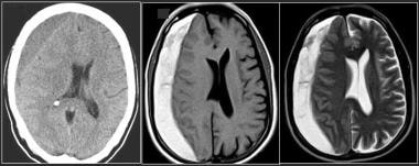 Subacute subdural hematoma in a right frontopariet