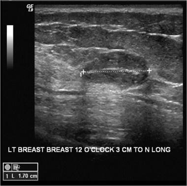 An ultrasound of a benign breast mass with circums