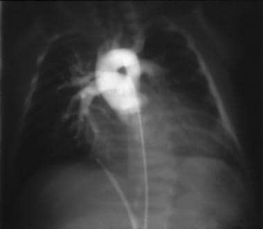 Truncus Arteriosus Imaging: Overview, Radiography, Computed Tomography