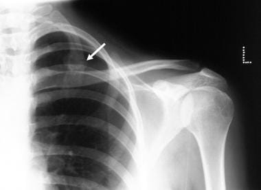 Radiograph of the left shoulder of a 36-year-old m