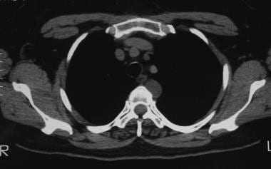 Solitary pulmonary nodule. CT scan that shows a le